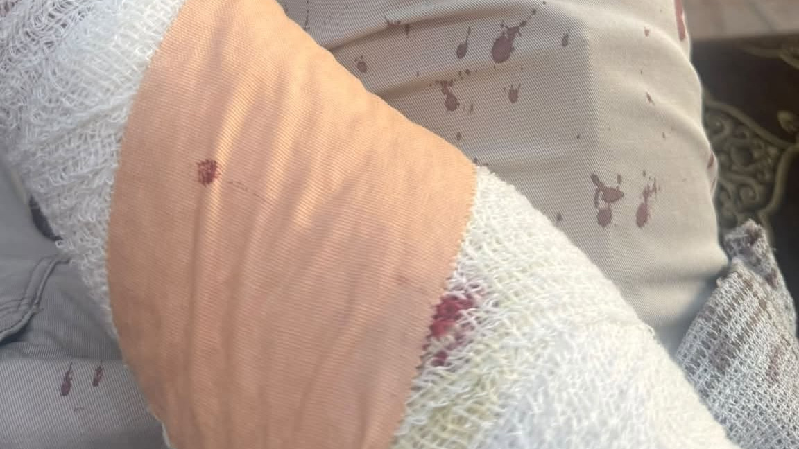 طالب يعتدي على معلم بـ "منشار" في الزرقاء